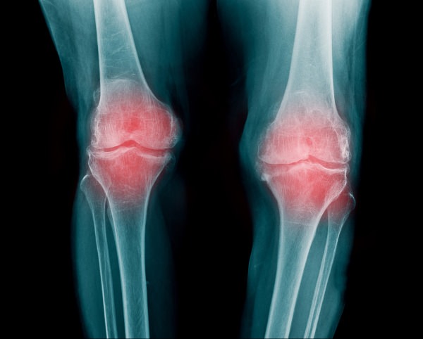 Diferencias entre Artritis y Osteoartritis